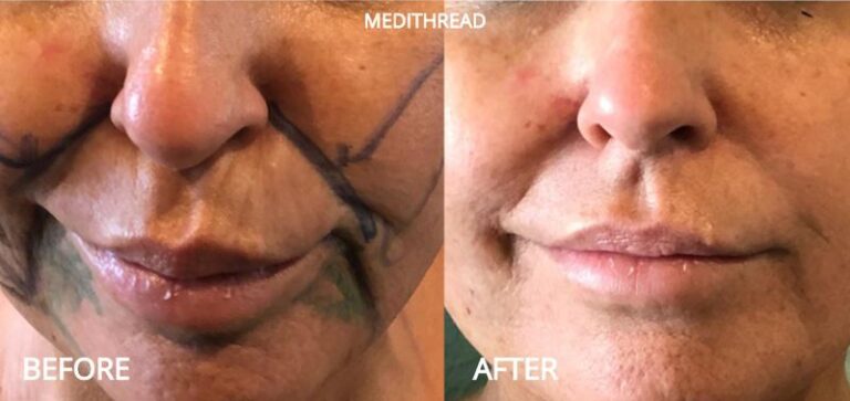PDO Threadlift Treatment in Setibamedicalspa Westlake Village CA