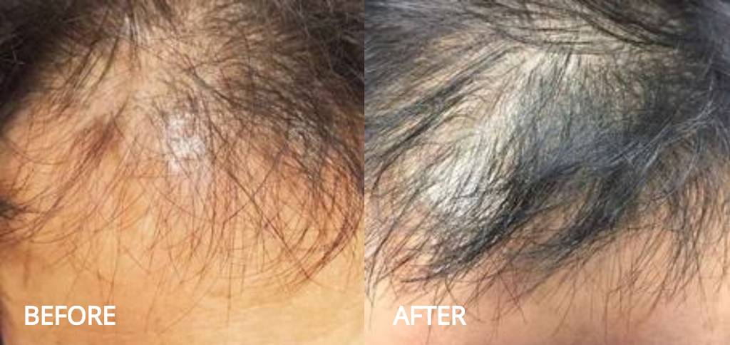 PRP Hair Restoration Treatment Setibamedicalspa Westlake Village CA
