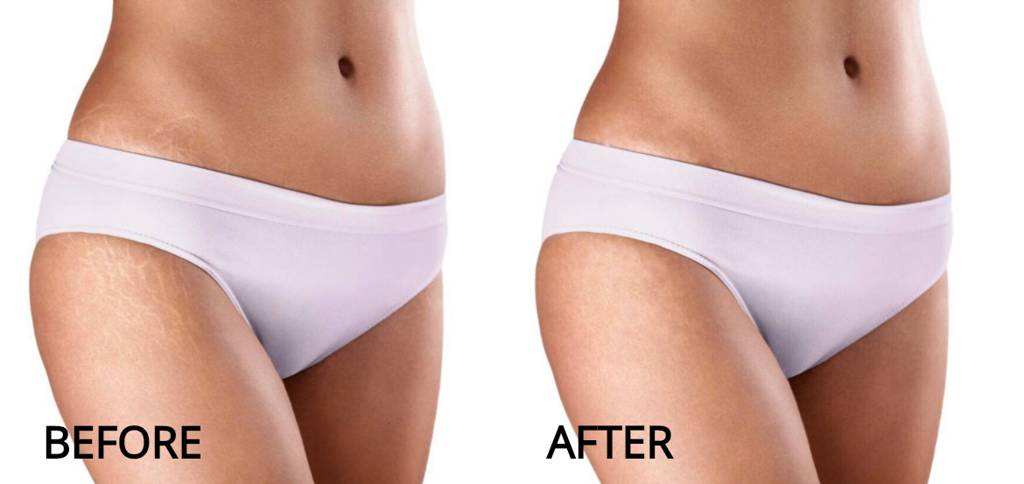 Stretch Marks Removal Treatment Setibamedicalspa Westlake Village CA