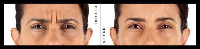 Xeomin Treatment Setibamedicalspa Westlake Village CA