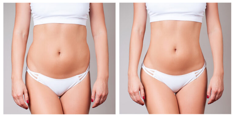 LIPO 360 Treatment in Setibamedicalspa Westlake Village CA
